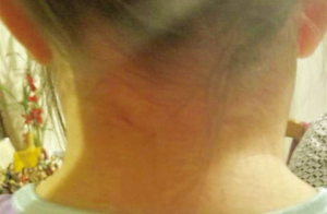 image of 8-year-old girl with swelling on right side of neck