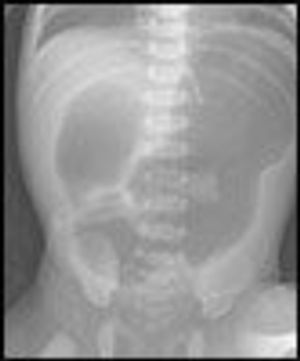 Duodenal Atresia in a Neonate