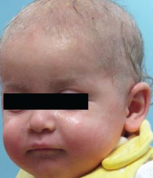 Wiskott-Aldrich Syndrome