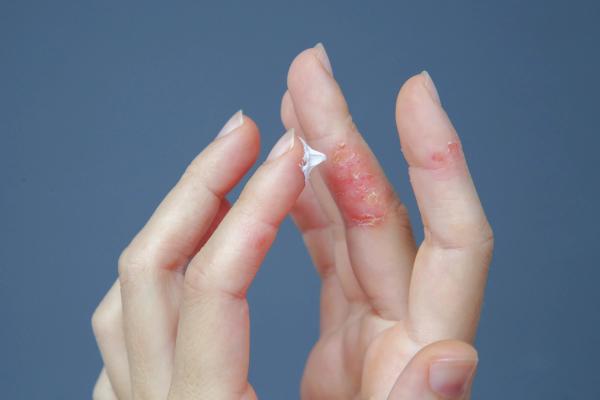 Arcutis reports positive phase 2 data for roflumilast cream in infants with atopic dermatitis | Image Credit: © triocean - stock.adobe.com.