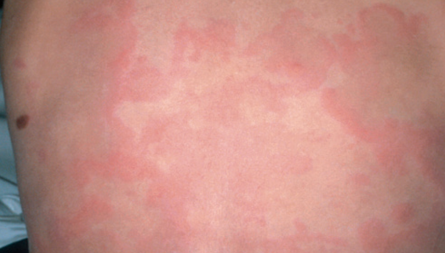 persistent-pruritic-rash-in-an-8-year-old-boy-contemporary-pediatrics