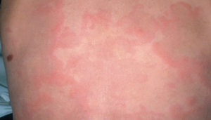 Persistent pruritic rash in an 8-year-old boy