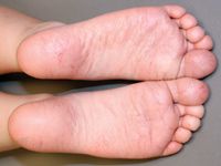 Young Girl Presents With Peeling Soles On Her Feet