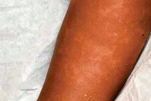 Streaky pigmentation suggests larger issues