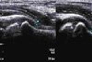 Bilateral Hip Effusions in a Child With Epstein Barr Viral Infection