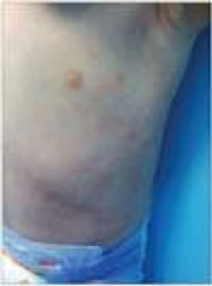 Unilateral Laterothoracic Exanthem