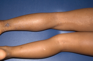Poll: What's the diagnosis of this linear eruption on the leg of a 9-year-old girl? | Image credit: Author provided