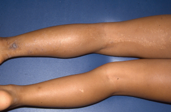 Linear eruption on the leg of 9-year-old girl