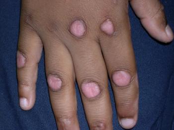 child with knuckle pads