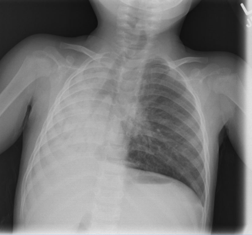 23-month-old female with cough, rhinorrhea, and increased work of breathing 23-month-old female with cough, rhinorrhea, and increased work of breathing