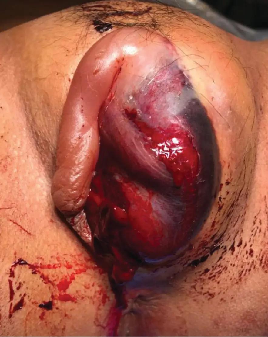Figure 1. A 12-year-old girl with vulvar hematoma Credit: Collection of Monica Woll Rosen, MD, University of Michigan