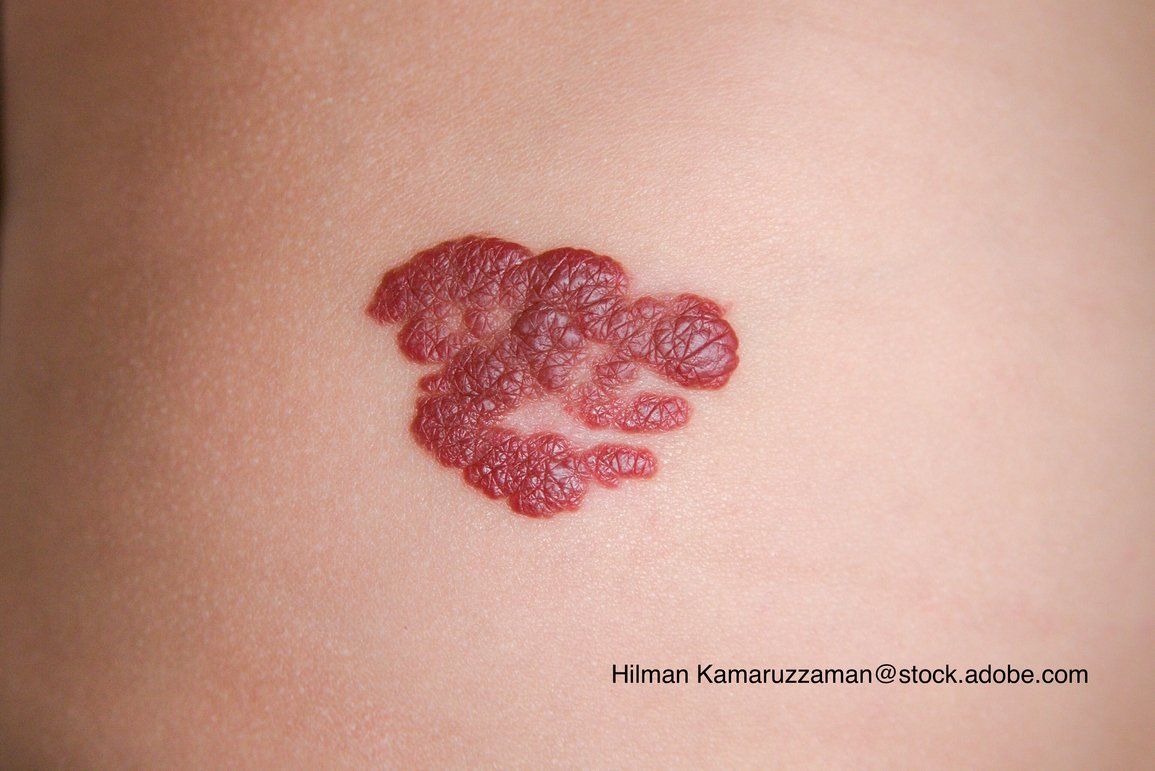 Recognize & Refer: Hemangiomas in pediatrics