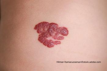 stock image of a hemangioma