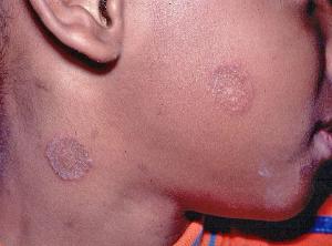 Skin Disorders: 2 Shots, 2 Tips