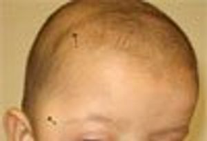Craniosynostosis