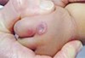 An Infected Finger: Child Abuse – or Mimic?