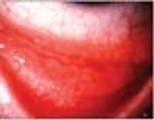 Young Girl With “Bumpy” Red Eye