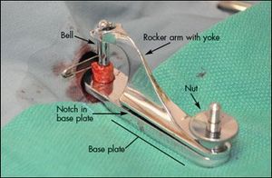 Newborn Circumcision: The Gomco Method