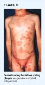 can psoriasis be surgically removed