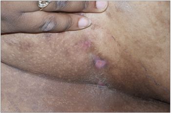 cigarette diseases Tobacco Use and Chronic Disease