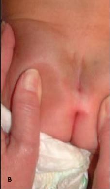 Sacral Epidermal Anomalies in an Infant