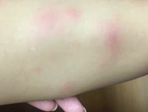Lower-extremity nodules in a 2-year-old girl