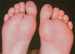 Juvenile Plantar Dermatosis: Readers’ Remedies