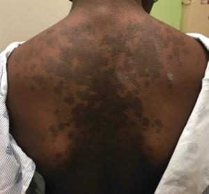 A 13-year-old girl with welldemarcated rash on back and chest | Image Credit: © Author provided - © Author provided - stock.adobe.com.