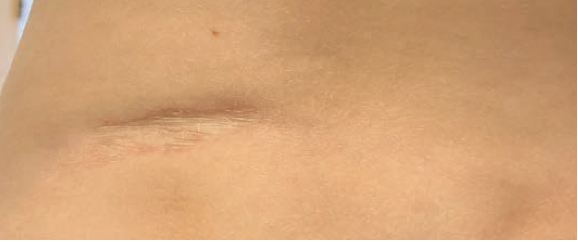 progressive plaque on child