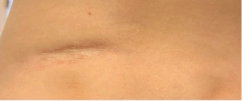 progressive plaque on child