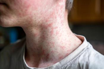 Measles vaccination coverage remains below herd immunity after postelimination outbreak | Image Credit: © Наталья Майшева - stock.adobe.com.
