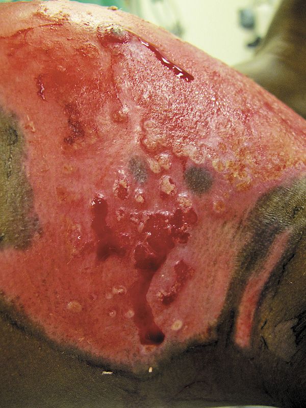 Treating infection in burns