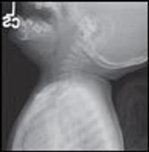 Child With Fever and Neck Pain