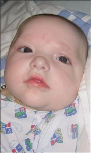 New-Onset Seizures in Infant With Square Facies, Hypospadias, and Hirschsprung Disease