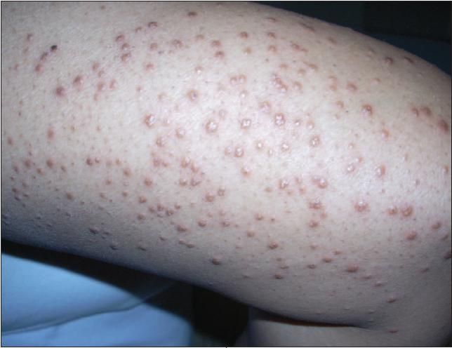 vitamin c lipid rash deficiency: Sign on your skin could be red flag warning of the illness Eruptive Xanthoma in a Teenager