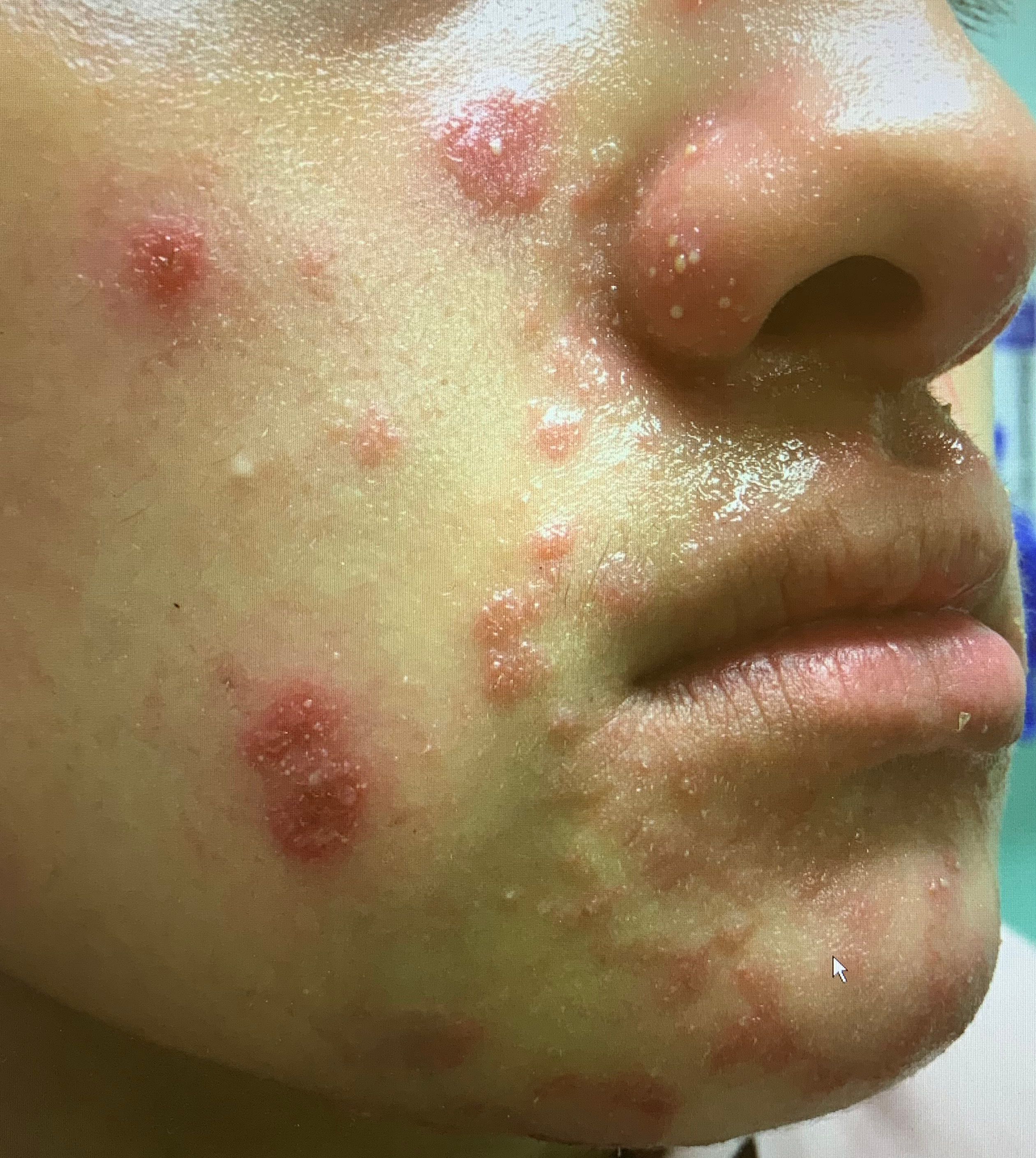 A 12-year-old patient presents with an inflammatory acneiform eruption across their face.