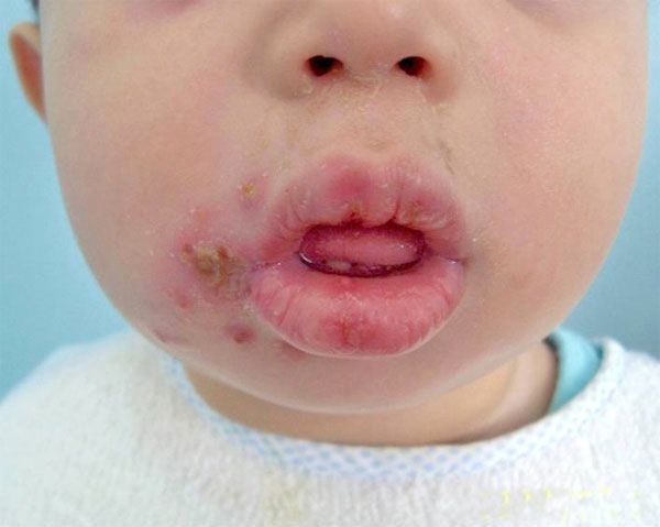 impetigo in children face