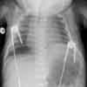Day-Old Boy With Respiratory Distress After Complicated Delivery