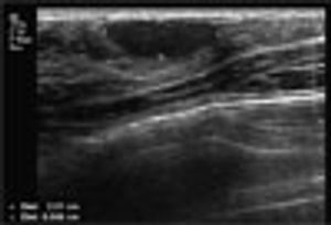 What Caused This Breast Lump?