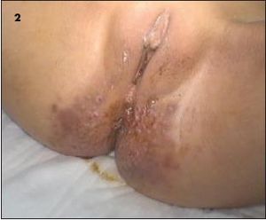Papular Perianal Rash in an 8-Year-Old Girl