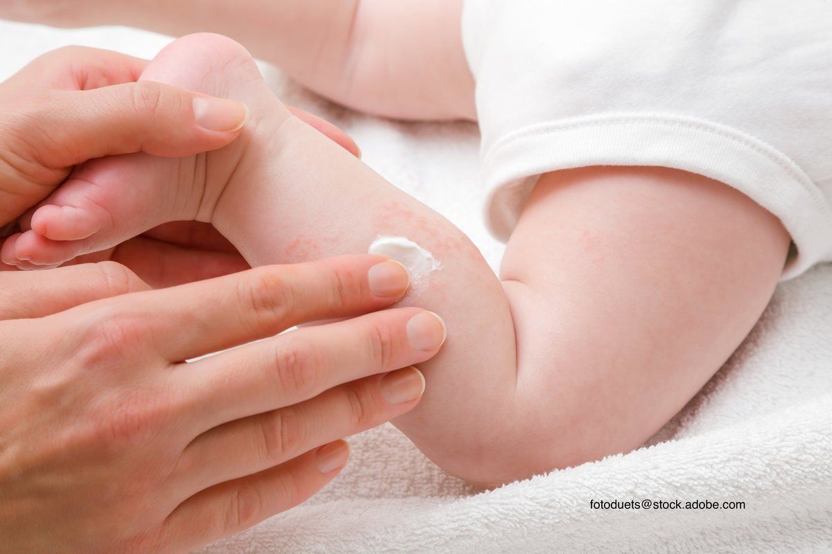 ointment being applied on baby