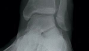 Teenager with ankle pain and swelling
