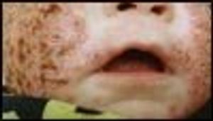 Eczema Herpeticum With MRSA Superinfection