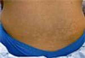 Progressive Macular Hypomelanosis of the Trunk