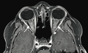 Bilateral blurry vision in a 9-year-old boy