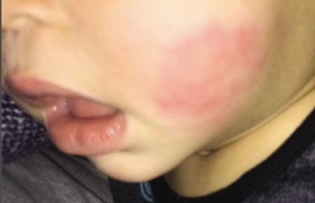Erythematous plaque on an infant’s cheek