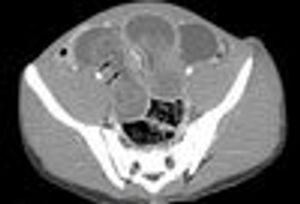 Intussusception: A Challenging Diagnosis in Adolescence