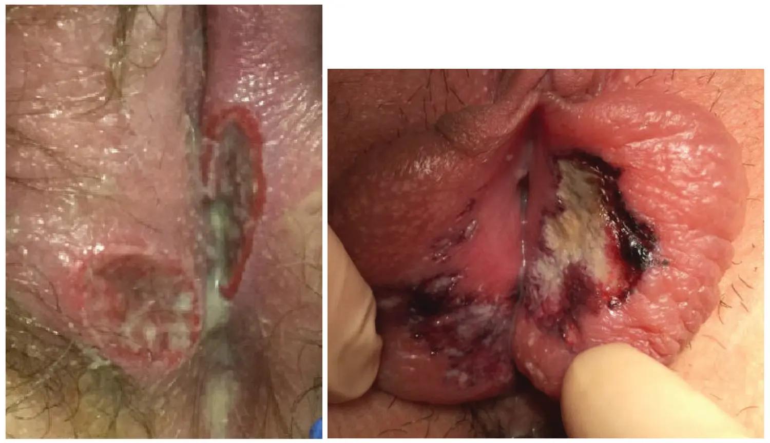 Aphthous or Lipshütz ulcers. Credit: Collection of Monica Woll Rosen, MD, University of Michigan