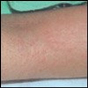 Allergic Reaction to Nickel in Swallowed Coins