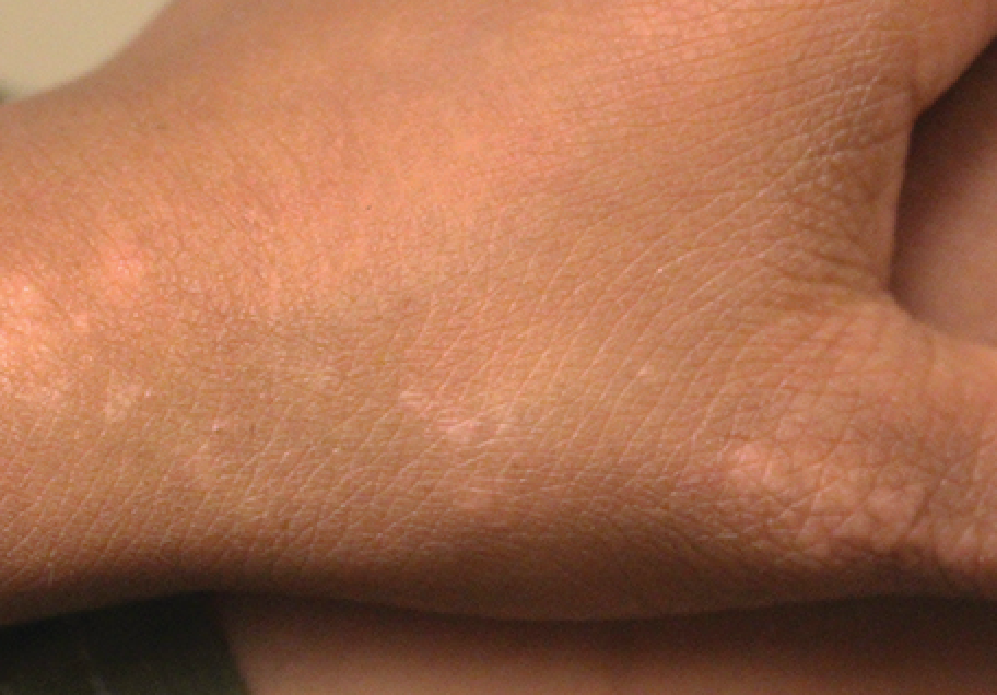 A 14‐year‐old girl with grouped flesh color papules and skin color
